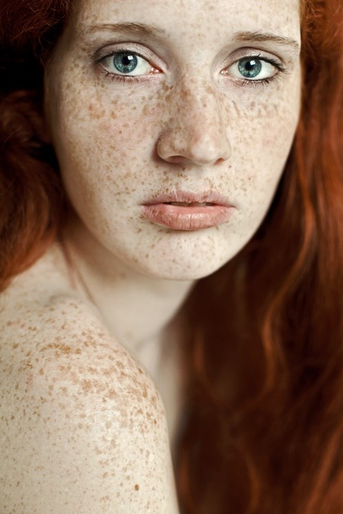 Teen Freckles