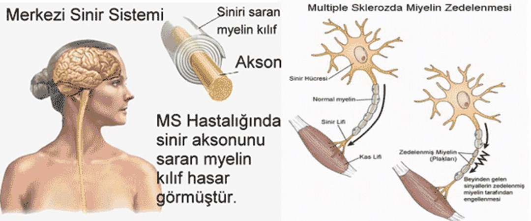 MS hastalığı hakkında merak ettikleriniz