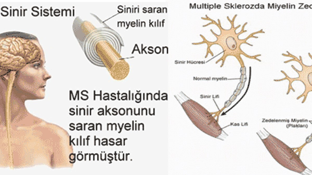 ms hastaligi hakkinda merak