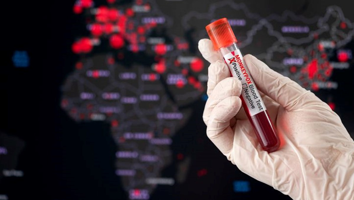 11 soruda maymun çiçeği rehberi: Maymun çiçeği nedir, belirtileri nelerdir? Maymun çiçeği nasıl bulaşır, ne zaman test yaptırılmalı? 11 soruda maymun çiçeği rehberi: Maymun çiçeği nedir, belirtileri nelerdir? Maymun çiçeği nasıl bulaşır, ne zaman test yaptırılmalı?