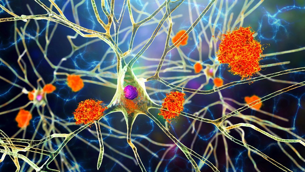 Alzheimer için umut veren keşif: İlk belirtiler gözlerde ortaya çıkıyor - 6