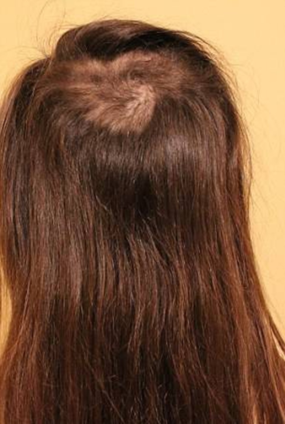 “Saç koparma tedavi edilebilir bir hastalıktır” (Trikotilomani nedir?) - 2