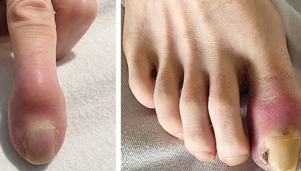Akciğer kanserine yakalandı: Parmakları bu hale geldi