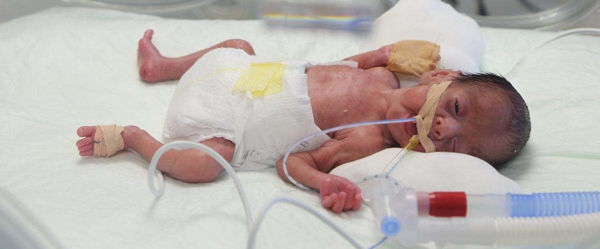 "Parmak bebeğin" kalbine müdahale Sağlık Haberleri NTV