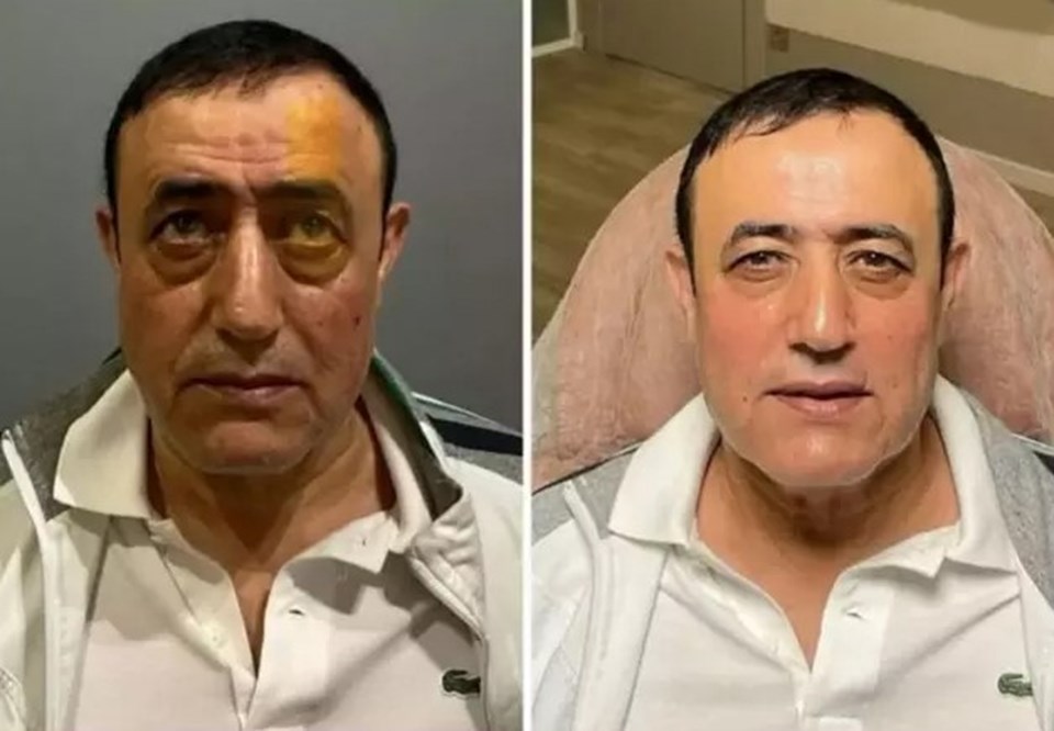 Mahmut Tuncer de estetik yaptırdı - 1