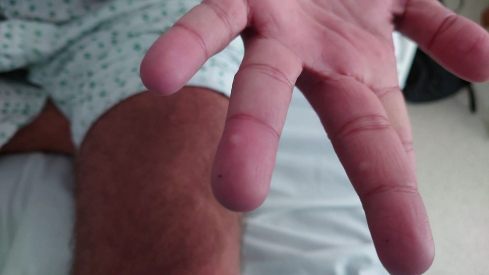 Dünyanın konuştuğu hasta: Önce HIV ve Covid sonra da maymun çiçeği - 4