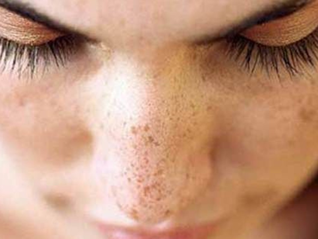 yuzdeki kahverengi lekeler sistemik bir hastaligin parcasi olabilir saglik haberleri ntv