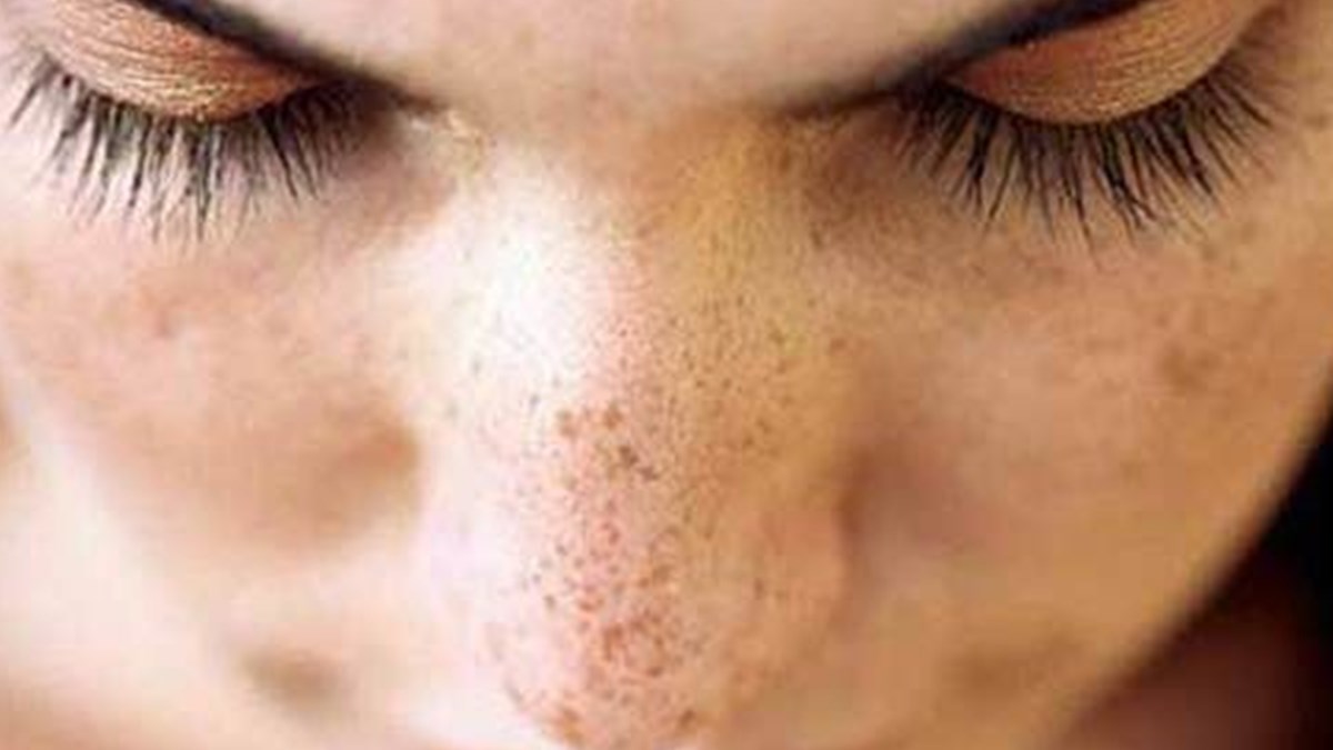 yuzdeki kahverengi lekeler sistemik bir hastaligin parcasi olabilir saglik haberleri ntv