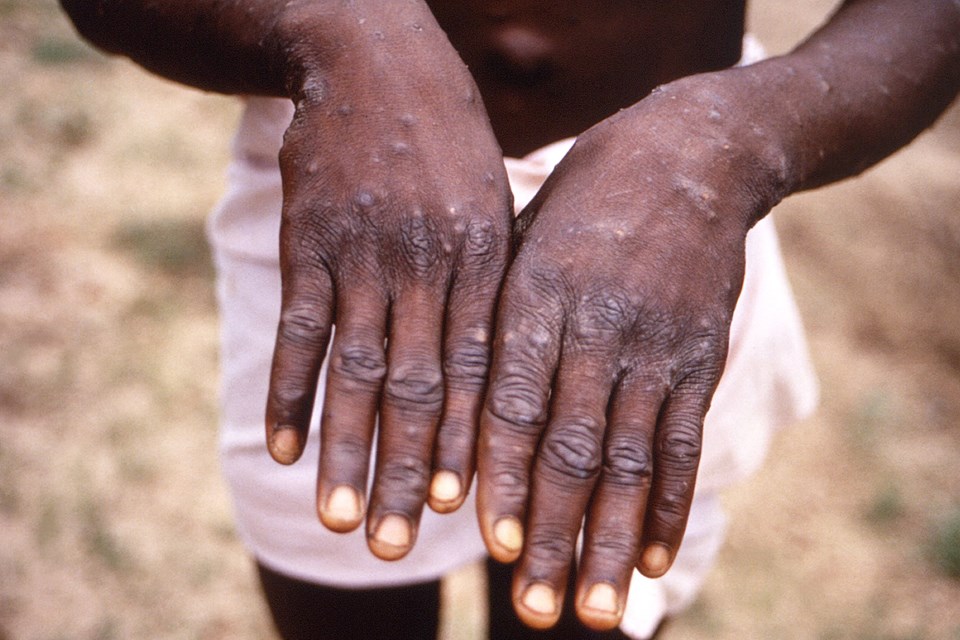 Maymun Çiçeği virüsü nedir, nasıl bulaşır? Maymun Çiçeği (Monkeypox) virüsünün belirtileri nelerdir, ölümcül mü, tedavisi var mı? - 2