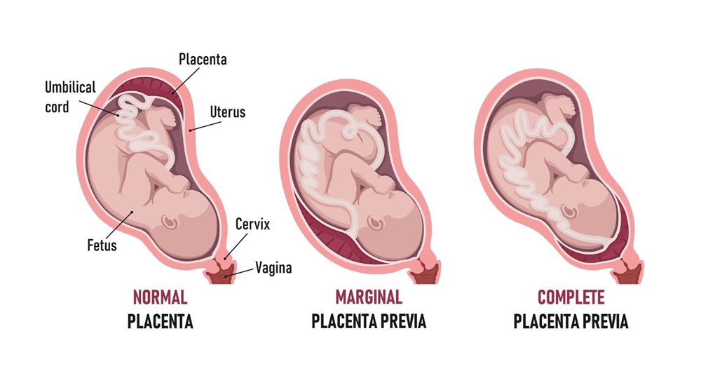 Harvard Üniversitesi: Covid-19’lu hamile ölümlerinin nedeni bebeğin cinsiyeti olabilir - 2