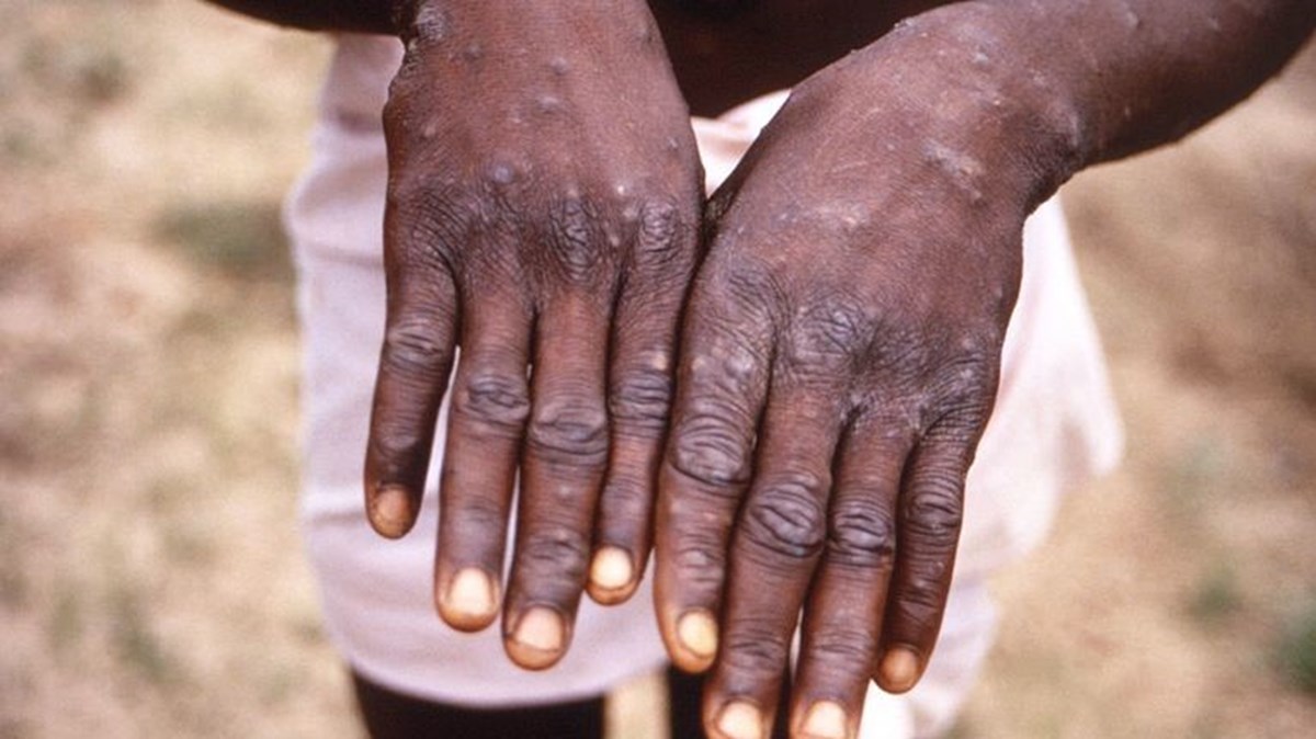 Afrikalı medya kuruluşları,  maymun çiçeği hastalığı haberlerinin sürekli olarak Afrikalılara yönelik fotoğraflarla verilmesini kınadı.