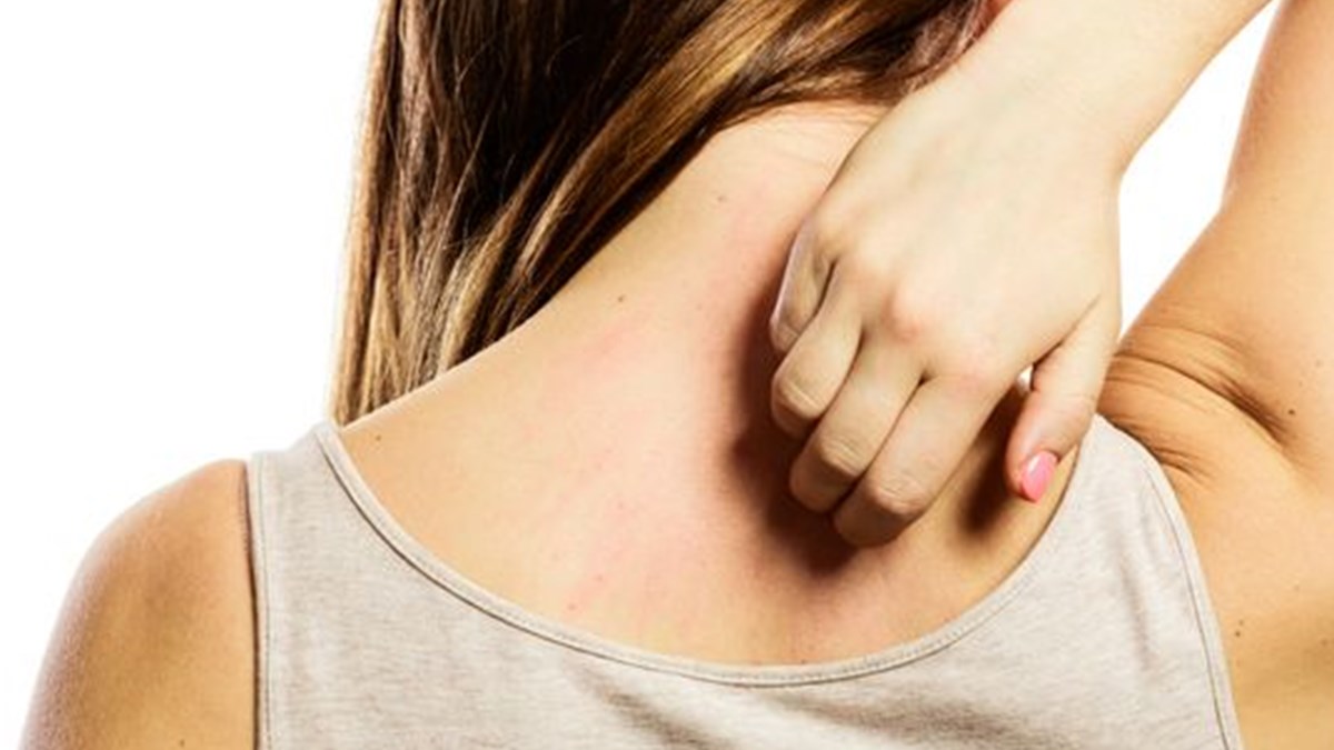 cilt kasintisi neyin habercisi