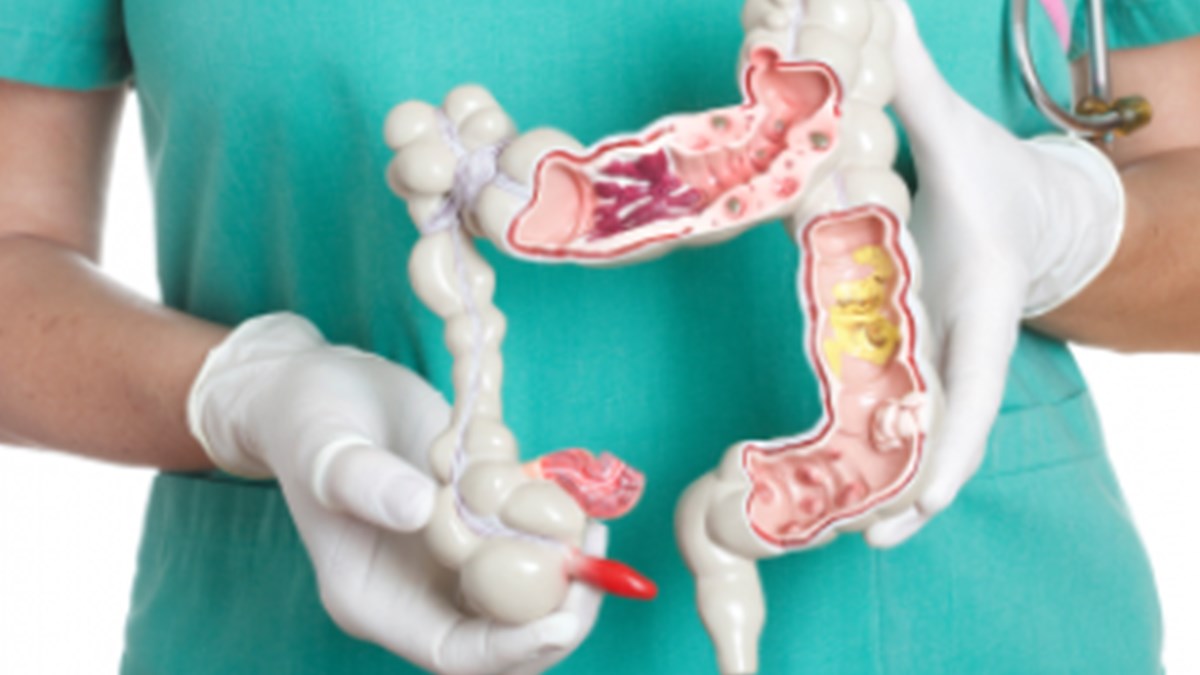 inflamatuvar bagirsak hastaliklari ibh