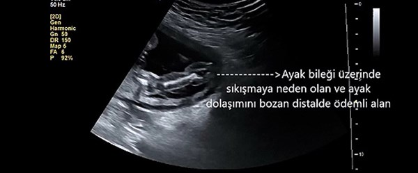 Ayaksız doğma riski vardı, anne karnında operasyon yapıldı