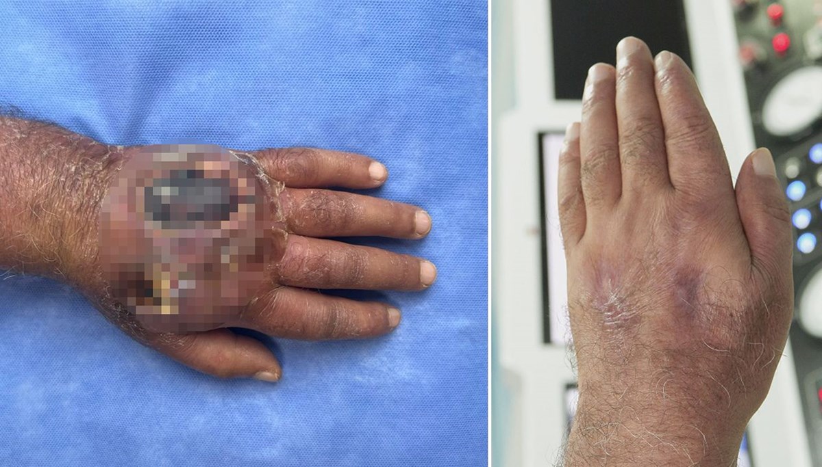 Doktorlar da şaşırdı: Hırsız öyle bir ısırdı ki; literatüre girmeye aday! Doktorlar da şaşırdı: Hırsız öyle bir ısırdı ki; literatüre girmeye aday!