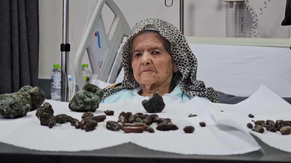 92 yaşındaki kadının midesinden ve bağırsaklarından çıktı: Kaç senedir yiyordum, zarar vereceğini düşünmedim - 1