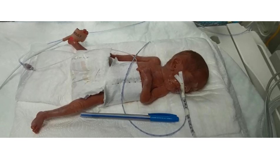 "Türkiye�de bir ilk, 285 gram doğan Elçin bebek hayata "Türkiye�de bir ilk, 285 gram doğan Elçin bebek hayata