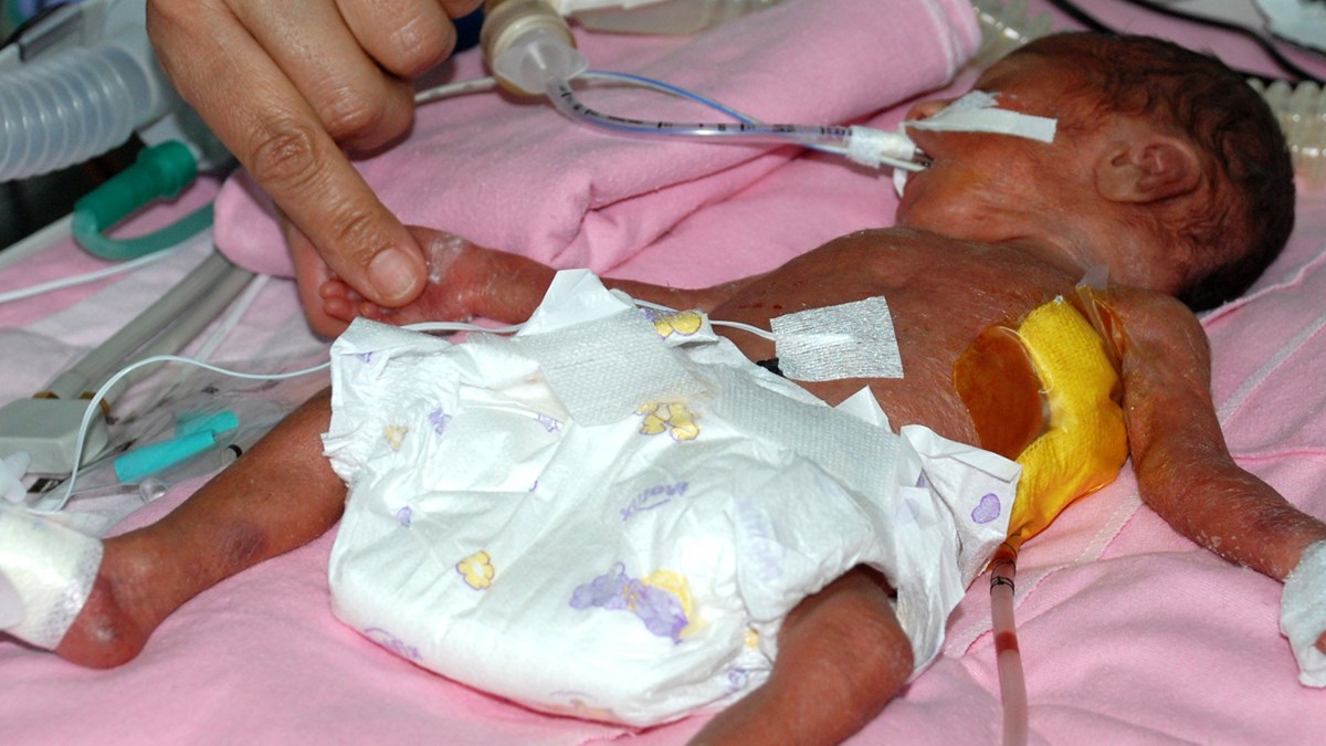 900 gramlik bebege kalp ameliyati ntv