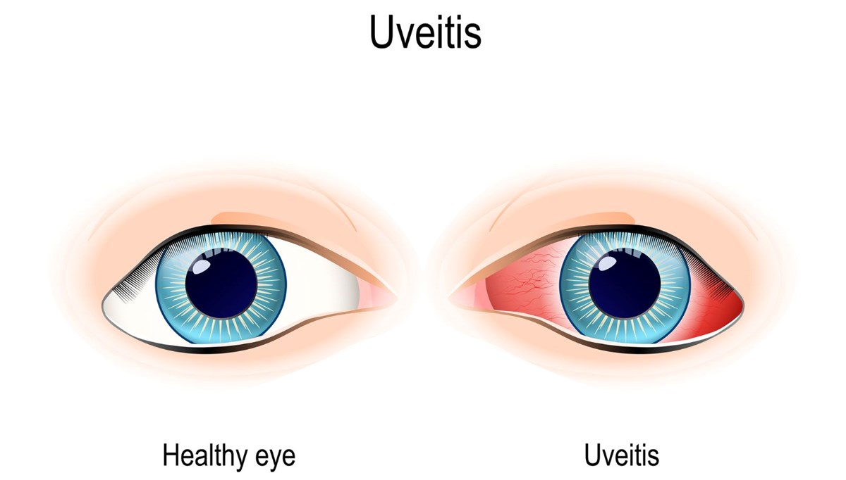 Üveit nedir? Belirtileri nelerdir? Nasıl tedavi edilir?