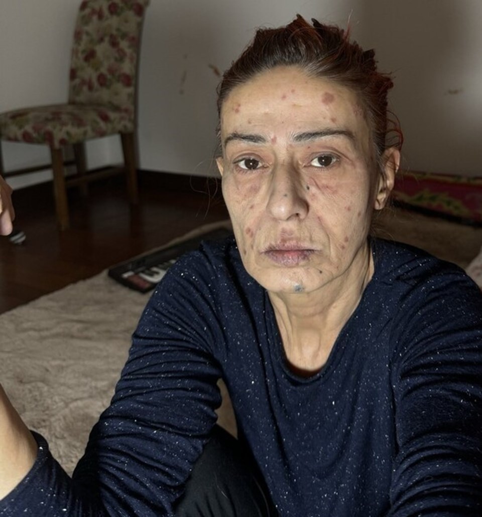Yıldız Tilbe'nin yüzünde yanıklar oluşmuştu: Olayın perde arkasını anlattı - 2