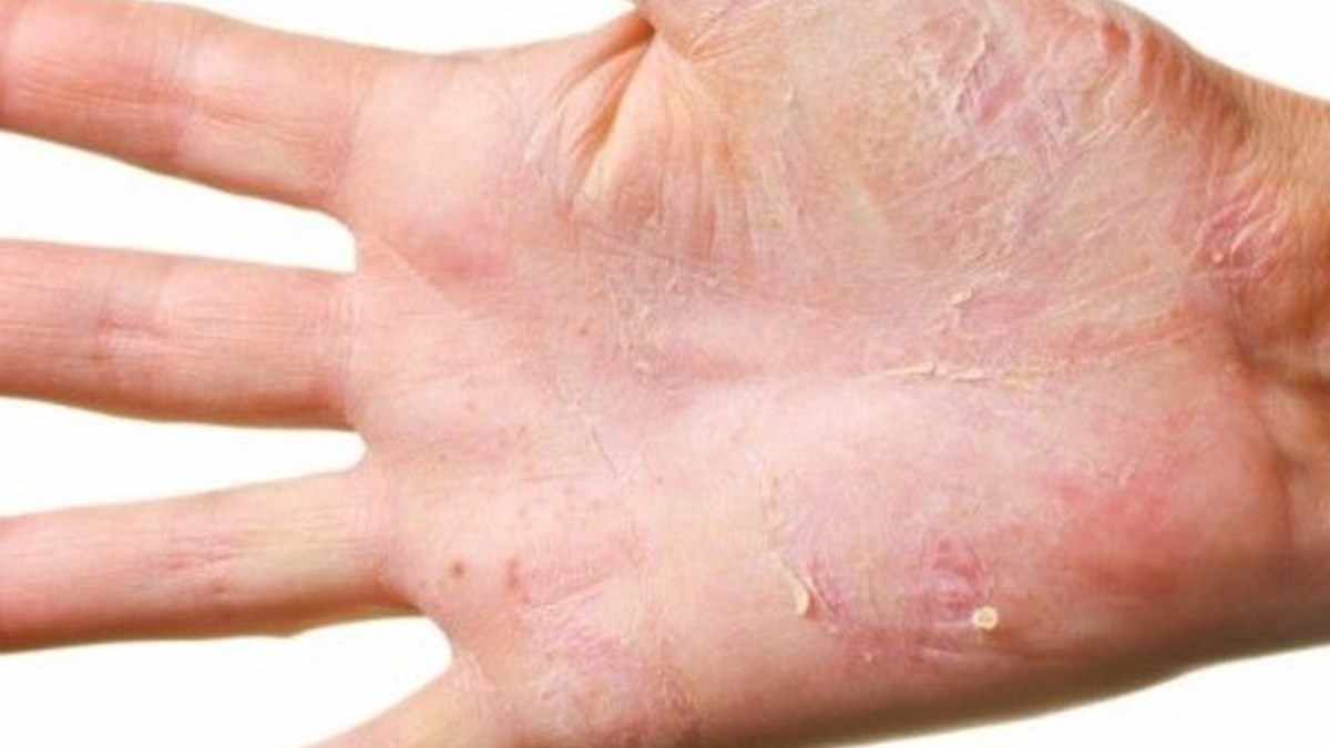 Egzamadan Korunmanin 12 Yolu Saglik Haberleri Ntv