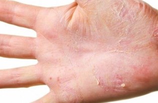 Atopik Dermatit Egzama Nedir Egzama Neden Olur Nasil Tedavi Edilir Saglik Haberleri Ntv