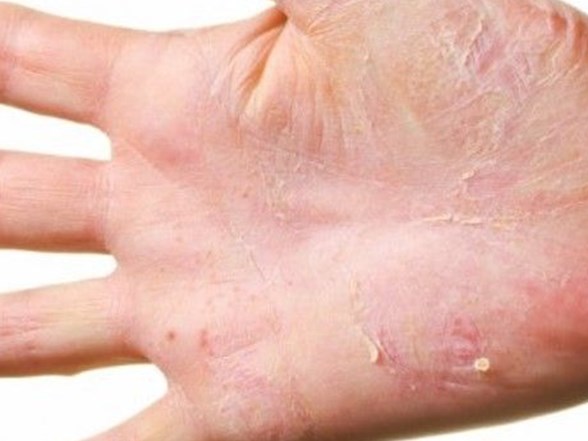 Egzamadan Korunmanin 12 Yolu Saglik Haberleri Ntv