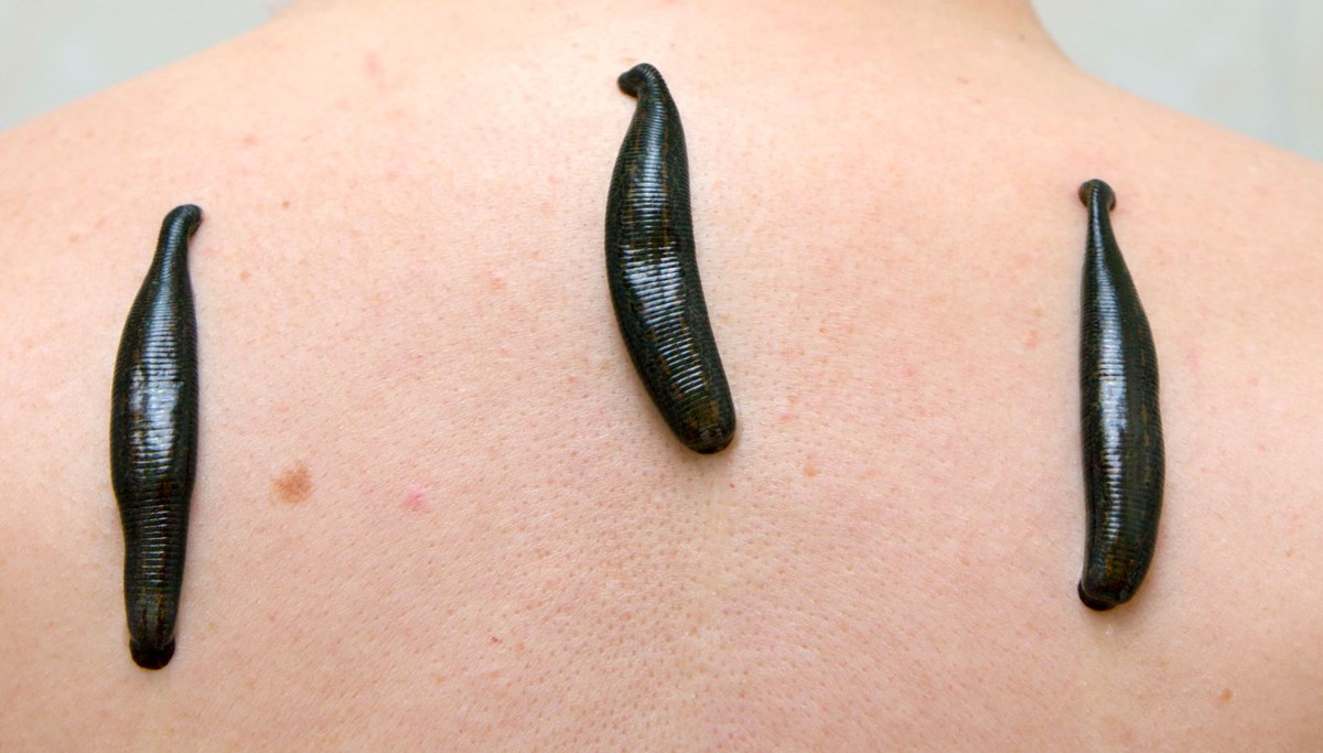 Apartman dairesinde sülükle tedavi ölümün eşiğine getirdi