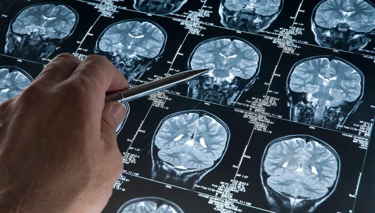 Travmatik olaylar Alzheimer riskini artırıyor olabilir Travmatik olaylar Alzheimer riskini artırıyor olabilir
