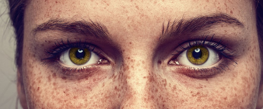 Sivilce Izleri Nasil Gecer Sivilce Lekeleri Icin Kesin Cozum Onerileri Guzellik Haberleri