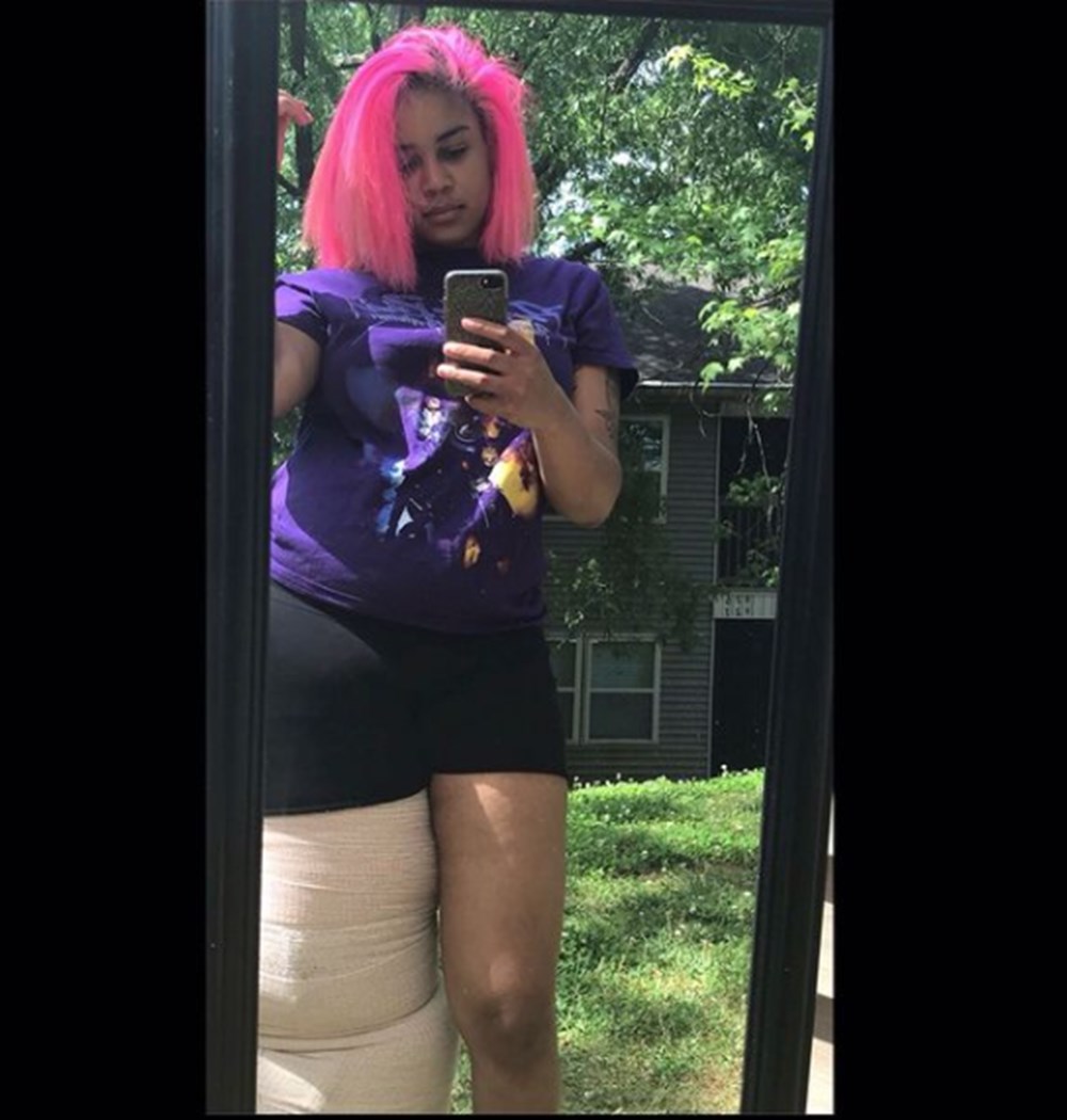 Doğuştan lenfödemili (fil hastalığı) Mahogany Geter acımasız eleştirilere rağmen görünüşüyle barışık yaşıyor - 7