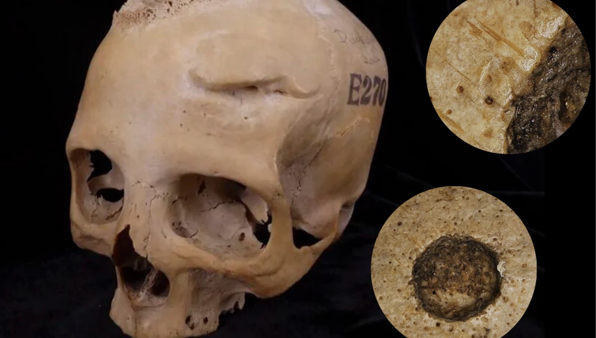 Antik Mısır'da kanser tedavisi: En eski ameliyat kalıntıları bulundu