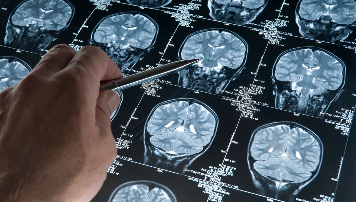 Alzheimer teşhisinde devrim! Yüzde 90 doğru tanı koyan kan testi