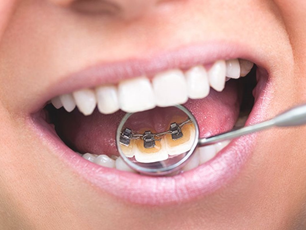 koruyucu ortodonti olabilir