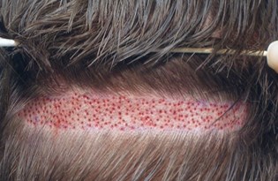 Sac Ekimi Hastane Ortaminda Yapilmali Istanbul Da Her Gun 5 Bin Sac Ekimi Yapiliyor Saglik Haberleri Ntv