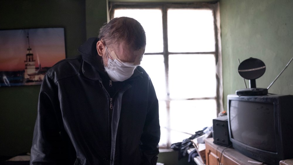 Cilt kanserinden yüzünü kaybeden baba: Kızımı öpmeyi çok özledim - 4