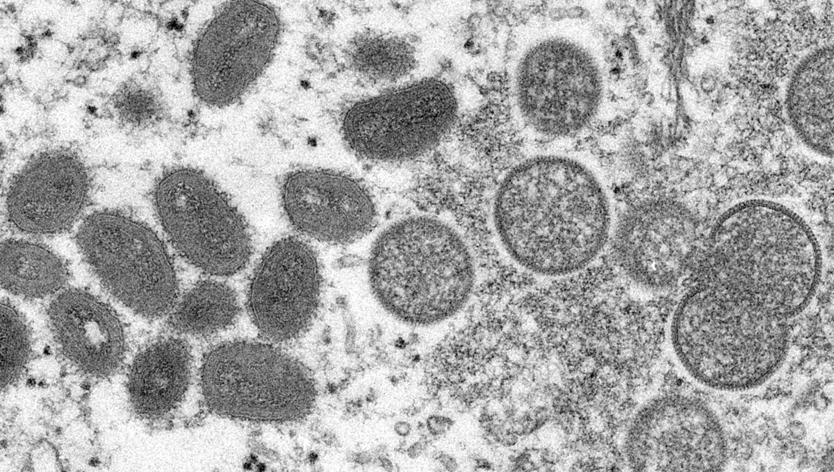 Avrupa'da maymun çiçeği virüsü alarmı: ABD'ye de sıçradı