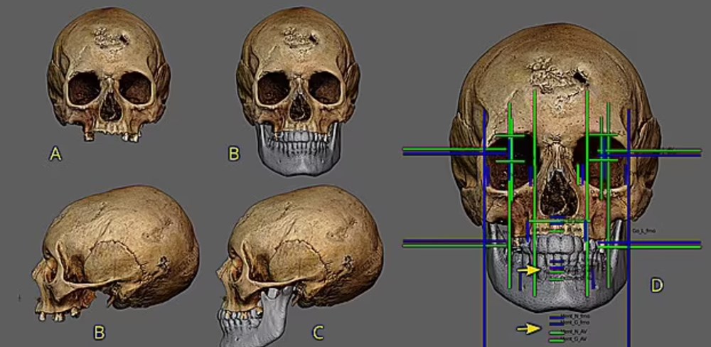 Cinsel hastalık kafatasını deldi: 500 yıl önce ölen kadın yeniden canlandırıldı - 3