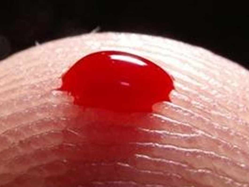 A Dan Z Ye Losemi Gercegi Saglik Haberleri Ntv