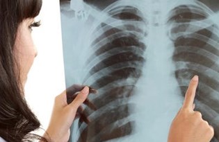 verem hastaliginin 8 belirtisine dikkat