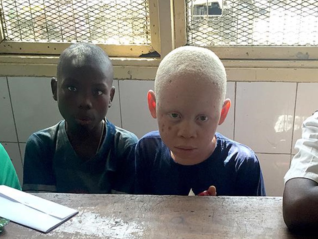 afrika nin talihsiz beyazlari albinolar saglik haberleri ntv