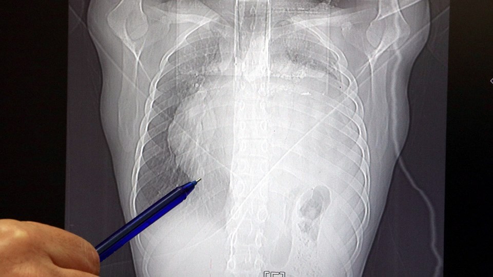 İstanbul'da doktorları bile şaşıran vaka! Kalbi 12 santim sağa kaydı - 3