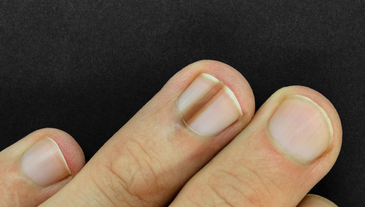 Kalp hastalığının gizli izleri: Ciltte 7 uyarı işareti var