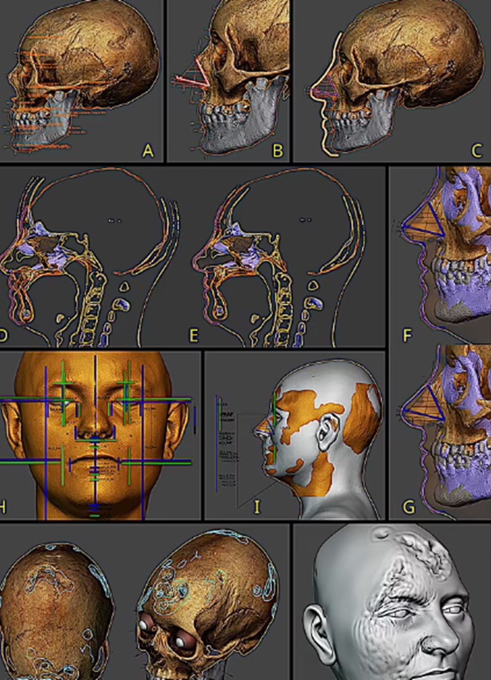 Cinsel hastalık kafatasını deldi: 500 yıl önce ölen kadın yeniden canlandırıldı - 5
