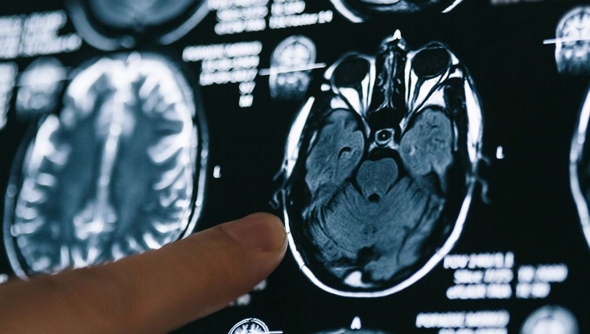 Alzheimer hastaları için gerçek bir tedavi sunan ilk ilaç: Lecanemab nedir? Lecanemab'ın yan etkileri nelerdir? Alzheimer hastaları için gerçek bir tedavi sunan ilk ilaç: Lecanemab nedir? Lecanemab'ın yan etkileri nelerdir?
