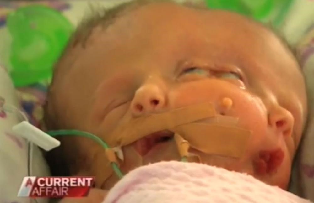 İki yüzlü ikiz bebek Magazin Haberleri NTV İki yüzlü ikiz bebek Magazin Haberleri NTV