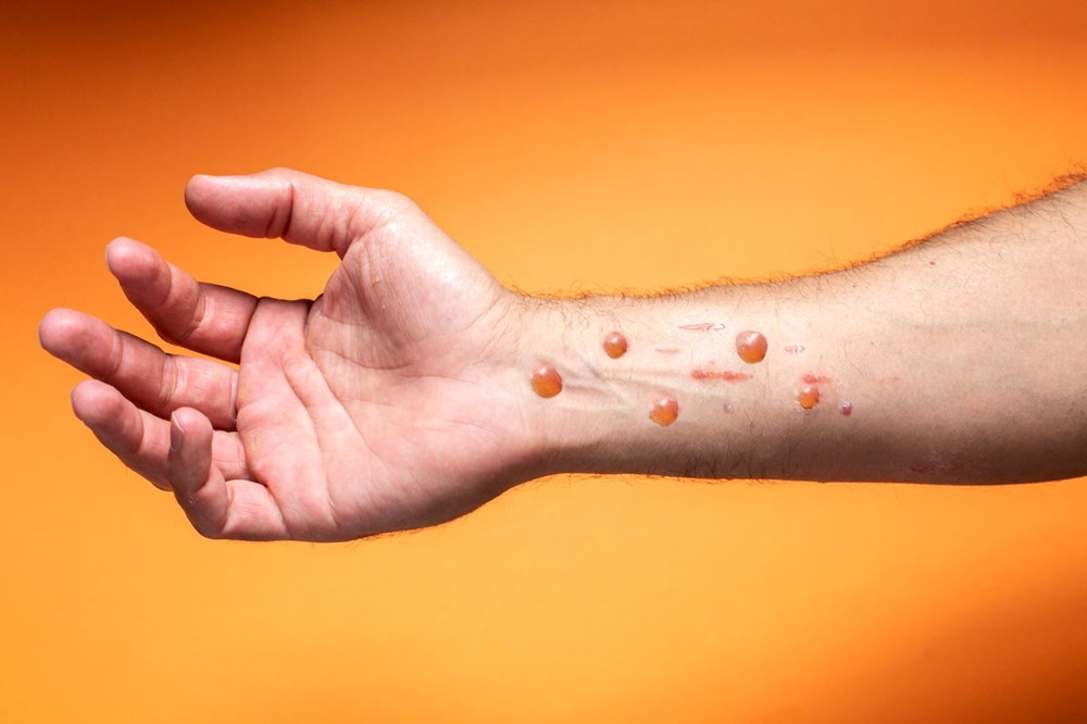 Sağlık Bakanlığı'ndan'maymun çiçeği' rehberi - 9