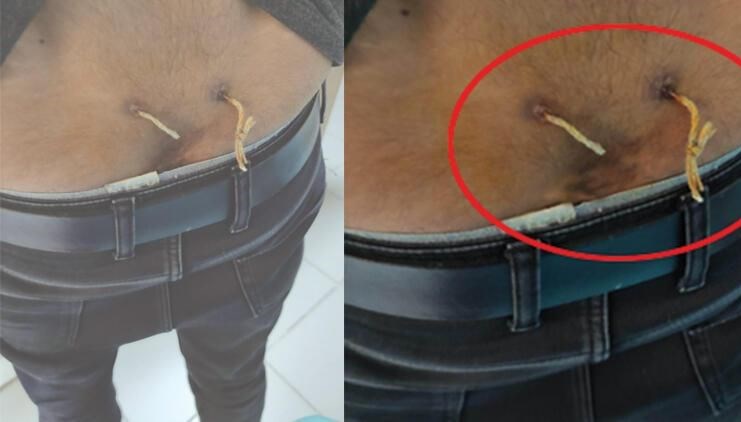 ‘Alternatif tıp’ adı altında işkence: Çamaşır ipiyle bel tedavisi