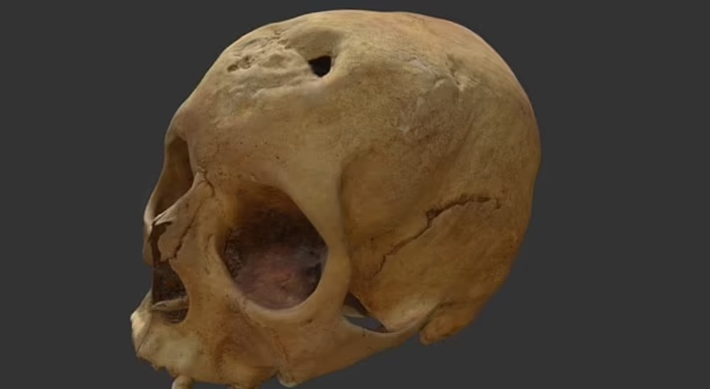 Cinsel hastalık kafatasını deldi: 500 yıl önce ölen kadın yeniden canlandırıldı - 2