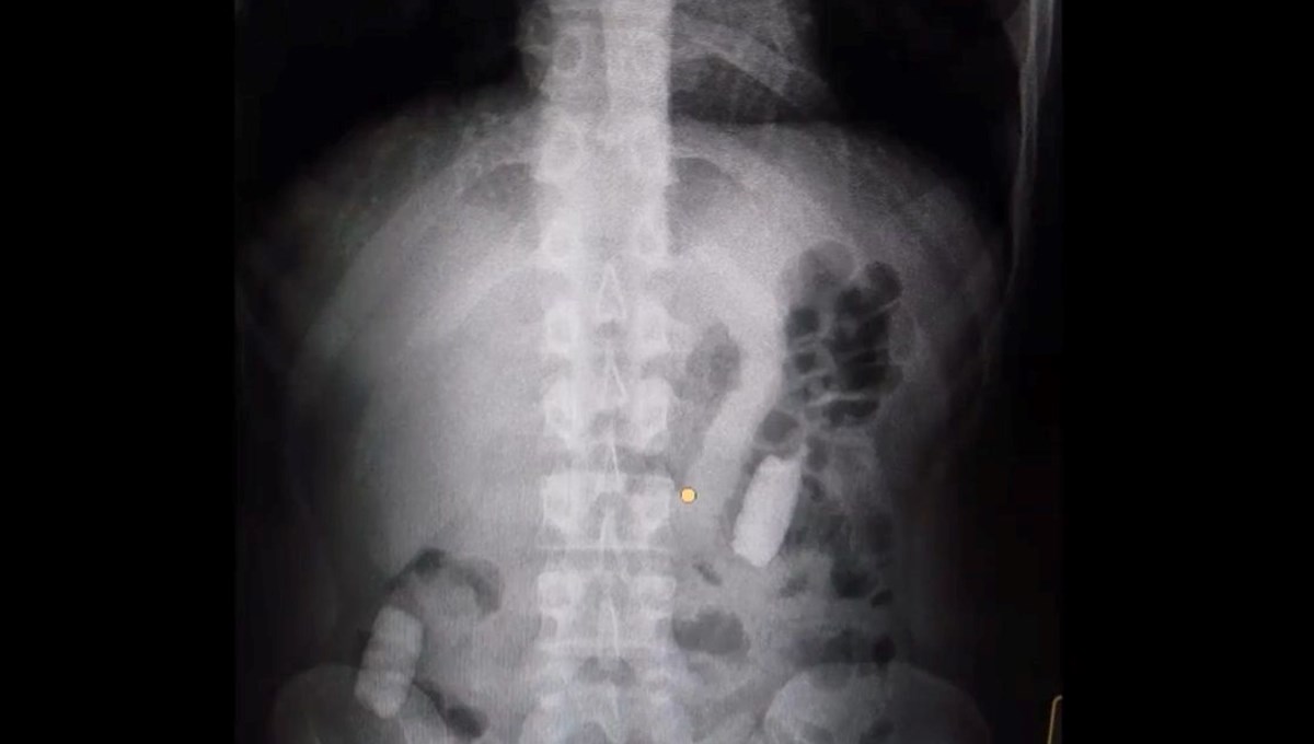 Midesinde taşıdığı 1 kilo uyuşturucuyla yakalandı Midesinde taşıdığı 1 kilo uyuşturucuyla yakalandı